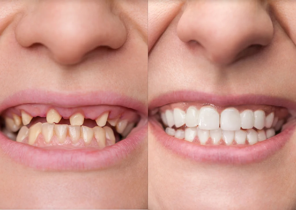 How long do Dental Crowns Last?